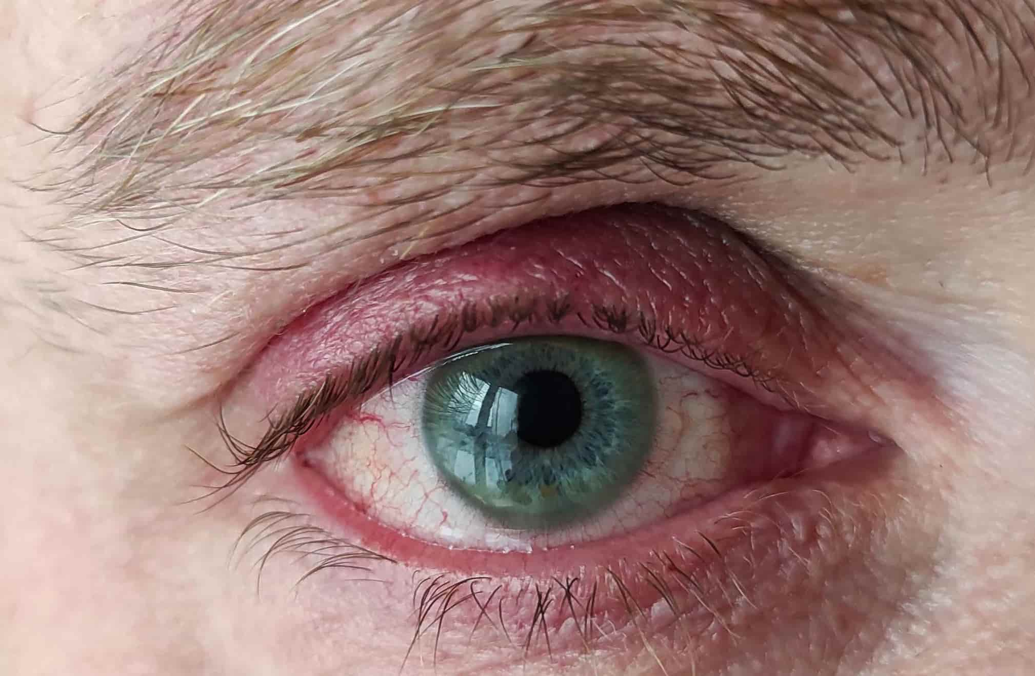 Close-up of a human eye with green iris, surrounded by red and slightly irritated skin, with visible eyelashes and eyebrows. The eye appears to be looking straight ahead.