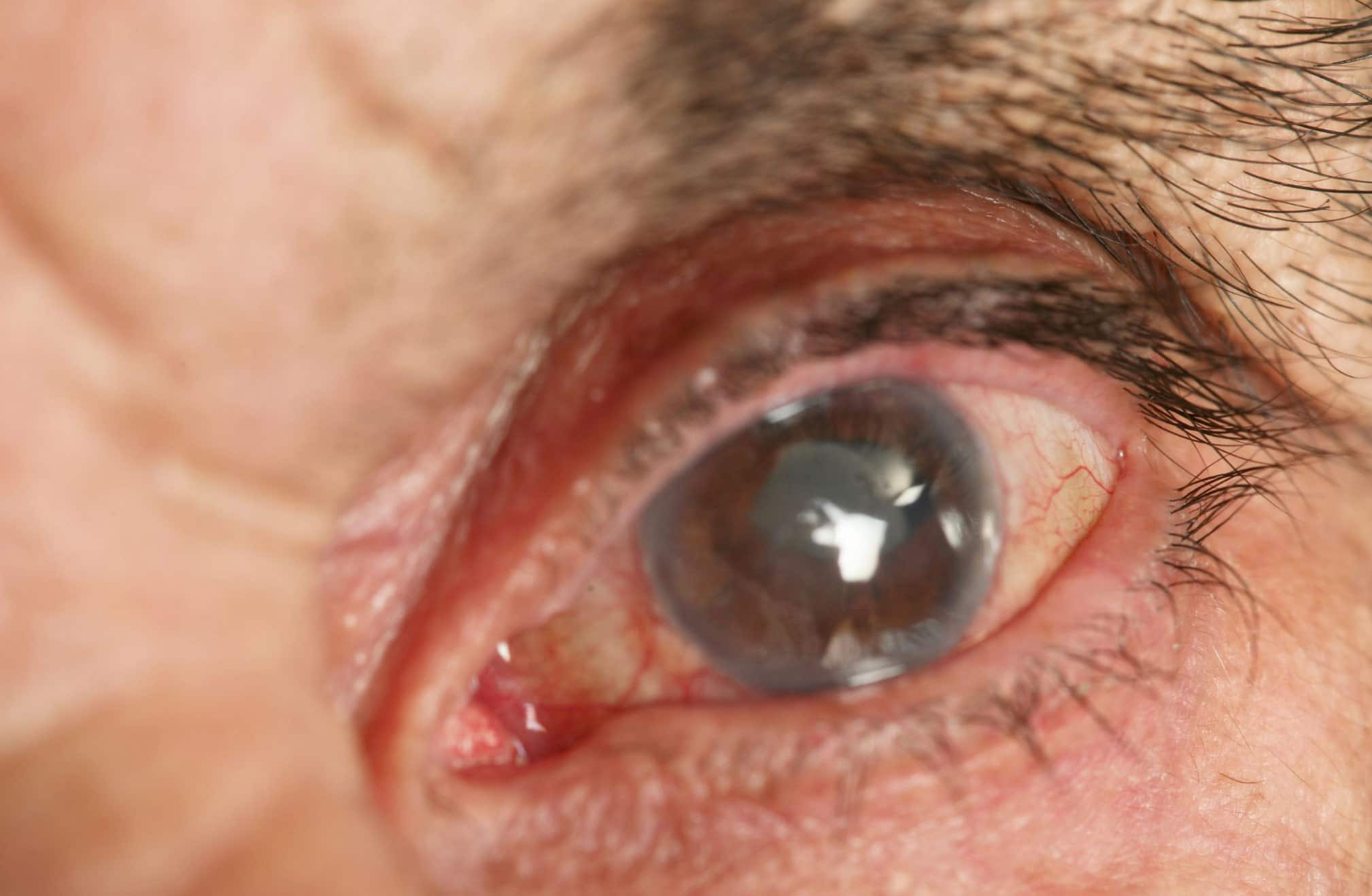 Close-up of a human eye with a cloudy lens, indicating cataracts. The surrounding area appears red and inflamed, with visible blood vessels.