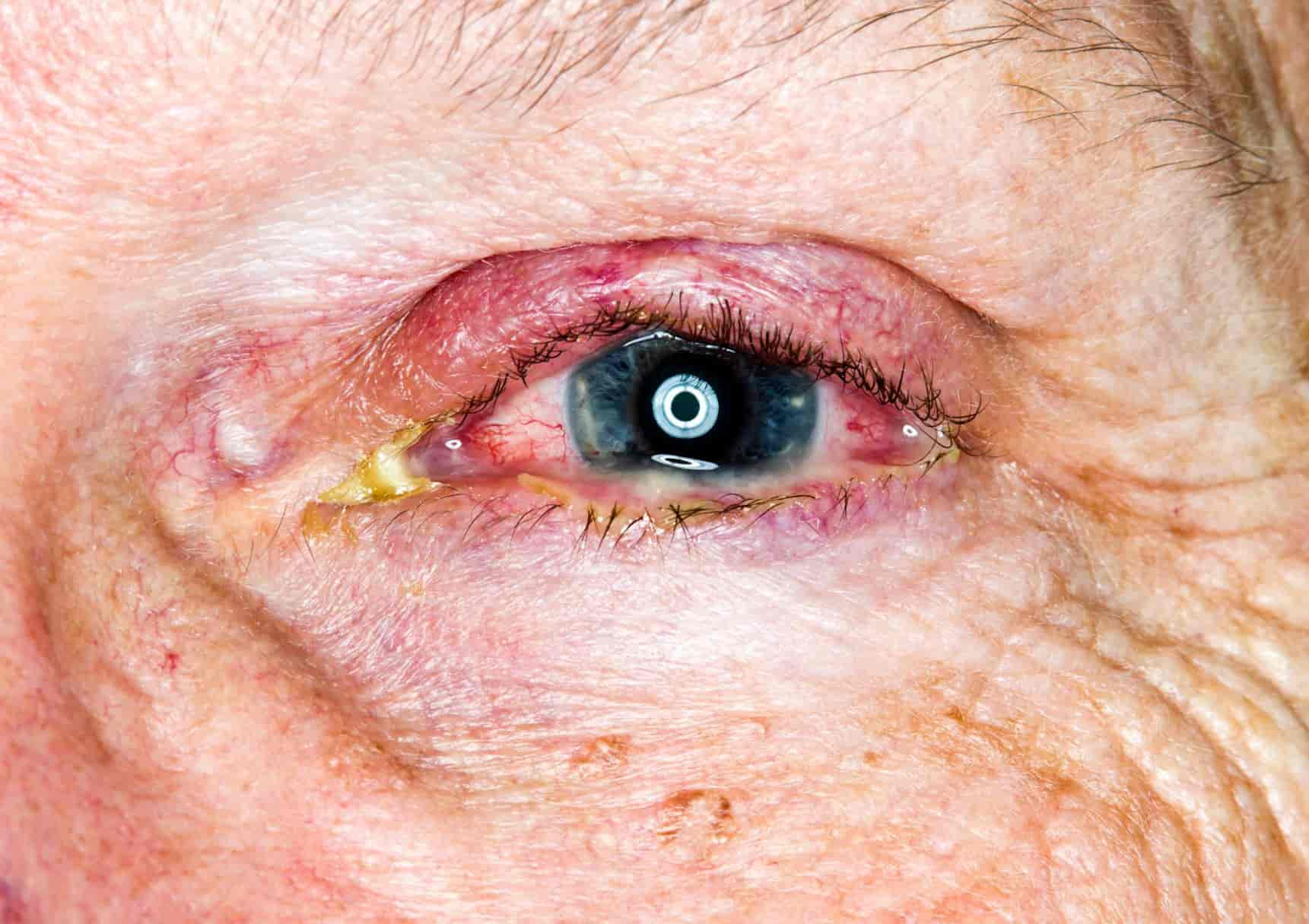 Close-up of an eye showing signs of redness and irritation, with visible blood vessels and a reflective ring of light on the pupil, indicating conjuctivitis. The surrounding skin is wrinkled, indicating aging.