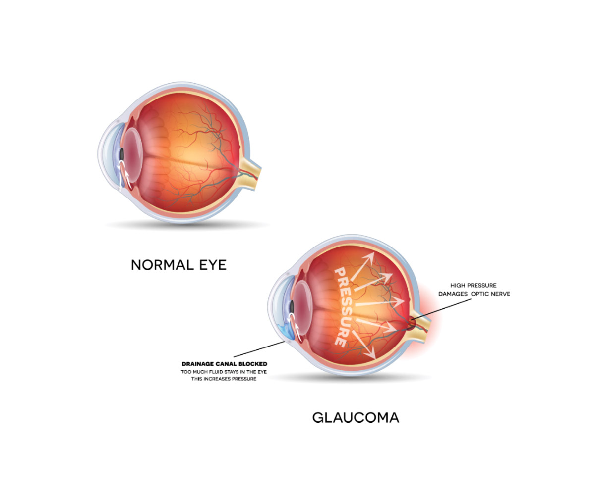 Illustration comparing a normal eye and an eye with glaucoma. The normal eye shows proper draining, while the glaucoma eye shows blocked drainage causing high pressure and optic nerve damage. Labels highlight differences in drainage and pressure.