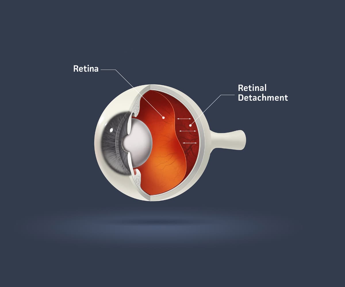 A cross-sectional diagram of an eye illustrates retinal detachment. The retina is labelled and shown peeling away from the back of the eye. The background is dark blue.